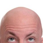 همه آنچه درباره ریزش موی مردان باید بدانید+ راهکارهای درمانی